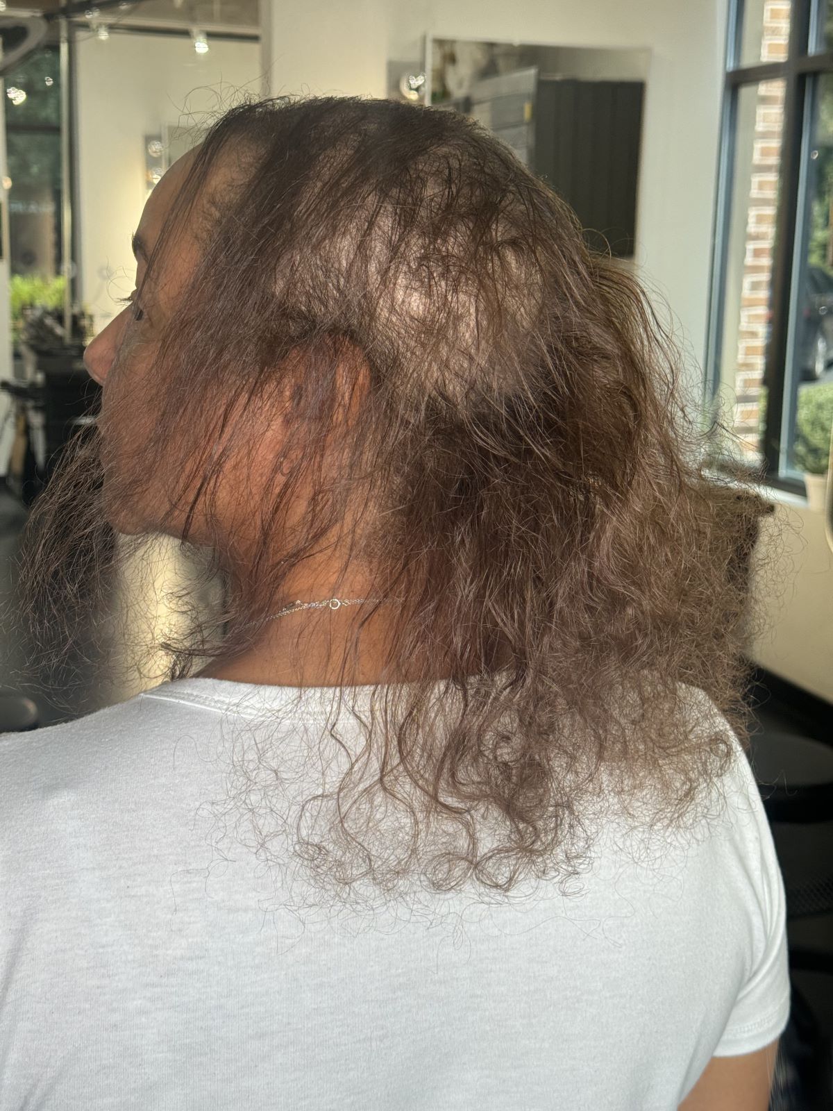 Before hair loss solution in Raleigh, North Carolina