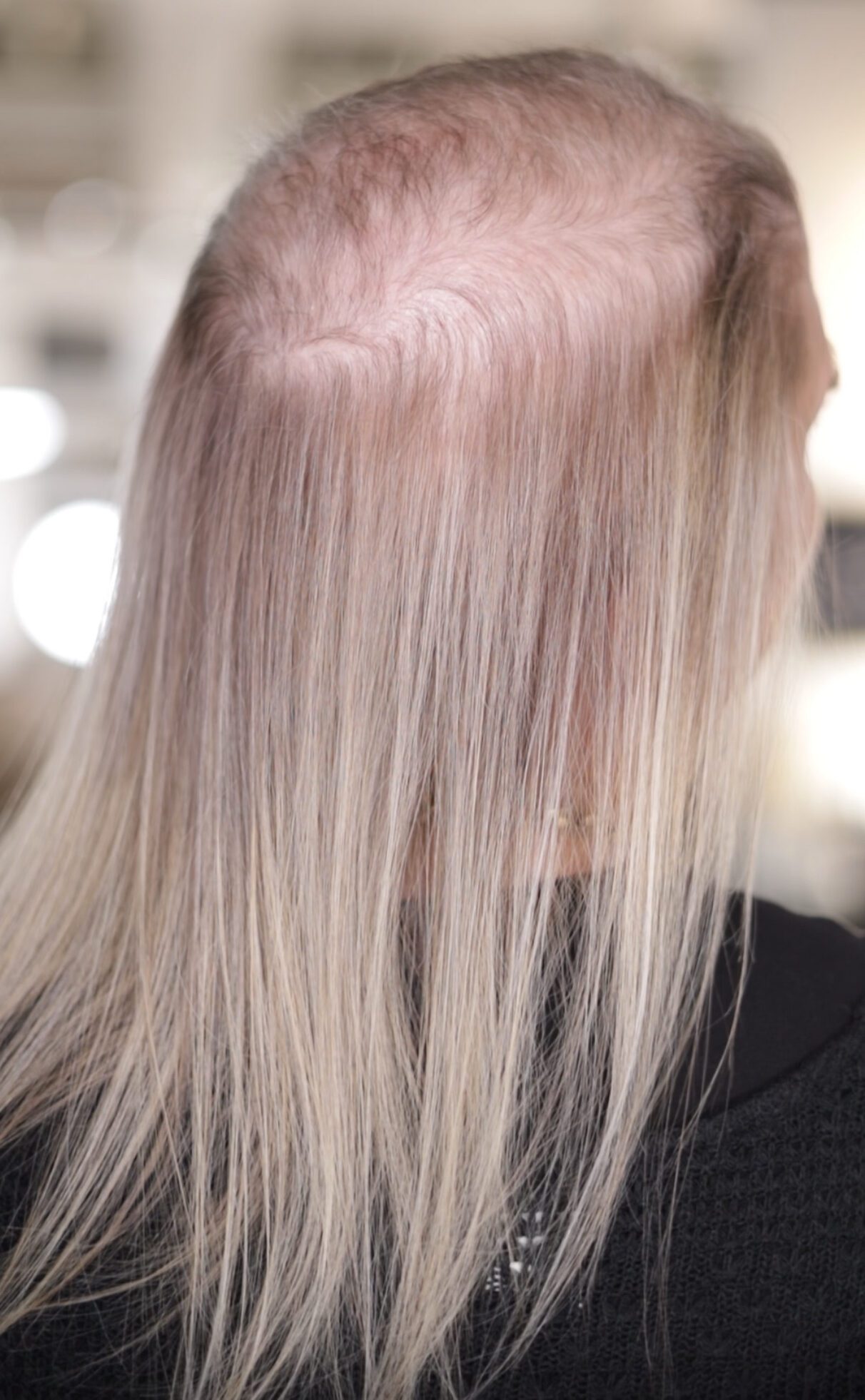 A Garnish guest's scalp showing a hair loss pattern common in women